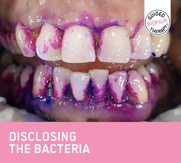 GBT guided biofilm therapy